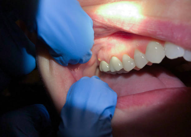 Best Urgent Tooth Repair  in Clarendon Hls, IL