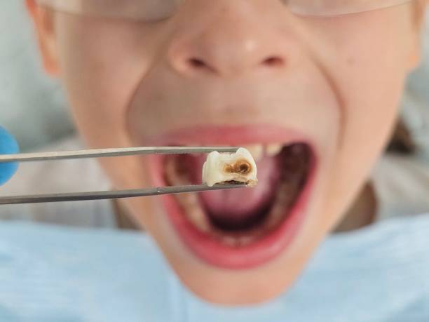 Best Emergency Dental Filling Replacement  in Clarendon Hls, IL